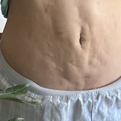 New Reflections Plastic Surgery - One year lipo results