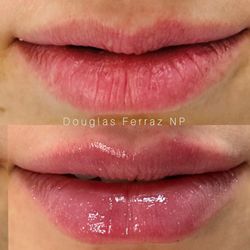 Juves Aesthetics  - Flawless looking lips.... Love it!!
