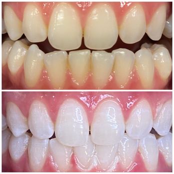 Deebeaut - Teeth Whitening Near Me Deebeaut - Teeth Whitening Near Me