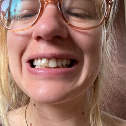 Soquel Dental Office - My little broken tooth