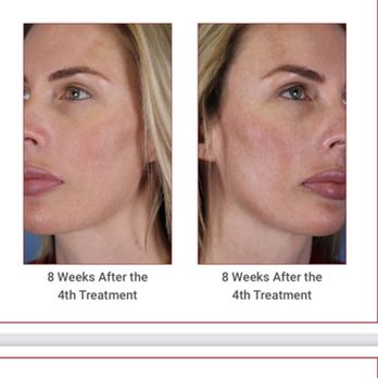 La Maison De Jolie - Melasma laser treatments - Medical Spas Near Me - Hauppauge, New York La Maison De Jolie - Melasma laser treatments - Medical Spas Near Me - Hauppauge, New York