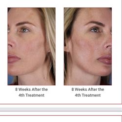 La Maison De Jolie - Melasma laser treatments