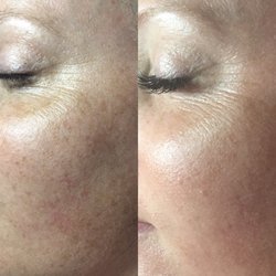 Skinovation Skincare & Waxing - Microneedling for pigmentation and fine lines