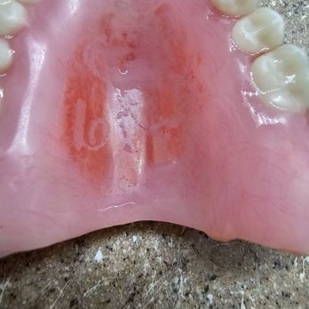 Fioritto Family Dental - Stained upper due to not being sealer properly. - Cosmetic Dentists Near Me - Mentor, Ohio