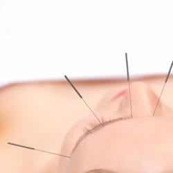 Won Wellness Center - Cosmetic Acupuncture