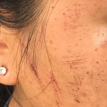 Wildflower Beauty Bar - This picture was taken about 36 hours after. (Right side of face.) - Skin Care Near Me - Gilbert, Arizona Wildflower Beauty Bar - This picture was taken about 36 hours after. (Right side of face.) - Skin Care Near Me - Gilbert, Arizona