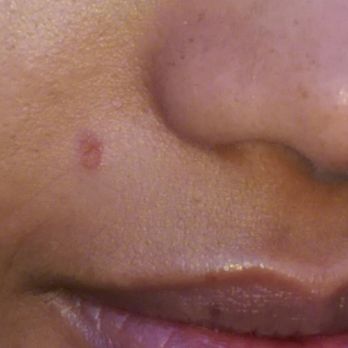 Charlie's - Hot water drops from the fog machine burned the skin off my face I hope they fix this issue - Dance Clubs Near Me - Denver, Colorado Charlie's - Hot water drops from the fog machine burned the skin off my face I hope they fix this issue - Dance Clubs Near Me - Denver, Colorado