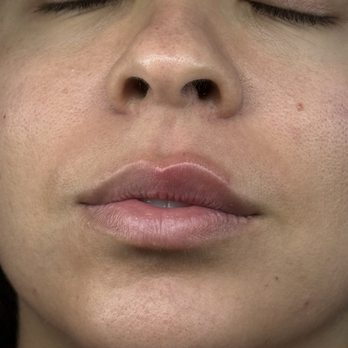 GC Skin Med Spa - Lip filler - Medical Spas Near Me - Sherman Oaks, California GC Skin Med Spa - Lip filler - Medical Spas Near Me - Sherman Oaks, California