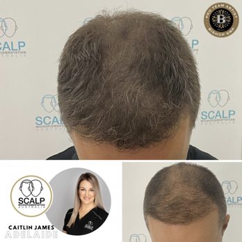 Scalp Micropigmentation Australia Adelaide - Before and After Scalp MicroPigmentation by Caitlin Adelaide - Hair Loss Centers Near Me - Walkerville, SA Scalp Micropigmentation Australia Adelaide - Before and After Scalp MicroPigmentation by Caitlin Adelaide - Hair Loss Centers Near Me - Walkerville, SA