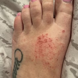 A few days after pedicure