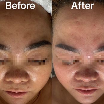 Skincare by Julia - After one facial treatment. - Day Spas Near Me - Brooklyn , New York Skincare by Julia - After one facial treatment. - Day Spas Near Me - Brooklyn , New York