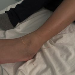 Pans Medical Center - Acupuncture for sprained ankle