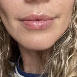 2 days after injection 2 days after injection