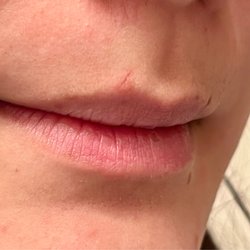 Skin House Facial Bar - Left side of my cupids bow is where she nicked me while dermaplaning