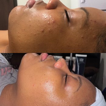 Janoir Skin and Lash - Here is a before and after of 3 months - Skin Care Near Me Janoir Skin and Lash - Here is a before and after of 3 months - Skin Care Near Me