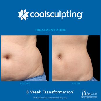 Thinique Skin & Wellness - We offer CoolSculpting at our Practice! - Weight Loss Centers Near Me - Fort Worth, Texas Thinique Skin & Wellness - We offer CoolSculpting at our Practice! - Weight Loss Centers Near Me - Fort Worth, Texas