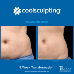 Thinique Skin & Wellness - We offer CoolSculpting at our Practice!
