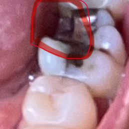 Molar broke off ...