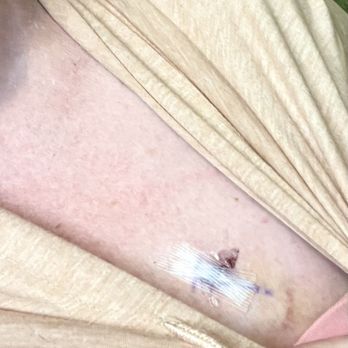 High Desert Heart & Vascular - ILR healed mostly healed within a week! - Cardiologists Near Me - Meridian, Idaho High Desert Heart & Vascular - ILR healed mostly healed within a week! - Cardiologists Near Me - Meridian, Idaho