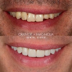 Orange and Magnolia Dental Studio - 10 porcelain veneers to fix broken teeth and brighten the smile