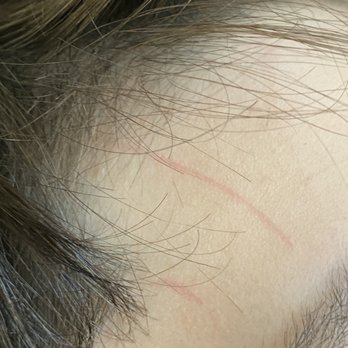 Moose's Barber Shop and Shave - Rash on forehead from haircut. (FOREHEAD!!) - Barbers Near Me - Chula Vista, California Moose's Barber Shop and Shave - Rash on forehead from haircut. (FOREHEAD!!) - Barbers Near Me - Chula Vista, California
