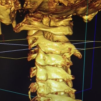 Advance Upper Cervical Chiropractic - 3D Image of neck - Chiropractors Near Me - Walnut Creek, California Advance Upper Cervical Chiropractic - 3D Image of neck - Chiropractors Near Me - Walnut Creek, California