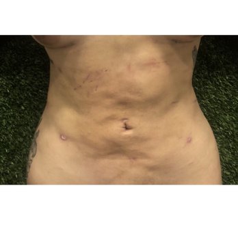 Body Sculpting By Cris - (December 18)   Abdominal liposuction- fibrosis, irregularity & build up of fat scar tissue - Skin Care Near Me - New York, New York