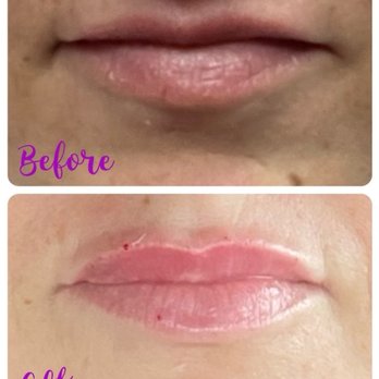 Dermatown Medical Spa - before and after - Medical Spas Near Me - Torrance, California Dermatown Medical Spa - before and after - Medical Spas Near Me - Torrance, California