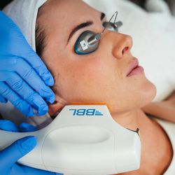 Derma Health Skin & Laser - Broadband Light (BBL) for sun damage, Rosacea, brown and red spots and fine lines and wrinkles.