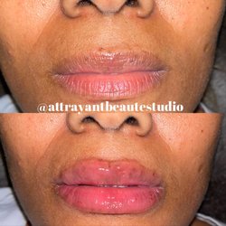 Attrayant Beauté Studio - Procedure: Natural Lip (1ML)