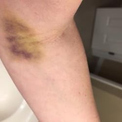 Quest Diagnostics - DON'T USE THIS CLINIC; THIS IS WHAT THEY DID TO MY ARM ON A ROUTINE BLOOD DRAW