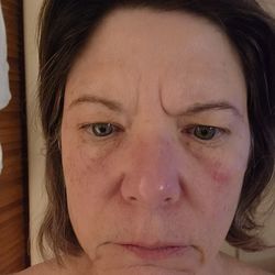 Studio 12 - The skin under my eyes are burned.