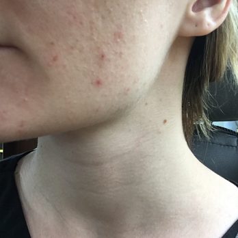 Luxe Day Spa Soho - Two of the painful scabs on my face after my Signature Facial - Day Spas Near Me - Tampa, Florida Luxe Day Spa Soho - Two of the painful scabs on my face after my Signature Facial - Day Spas Near Me - Tampa, Florida
