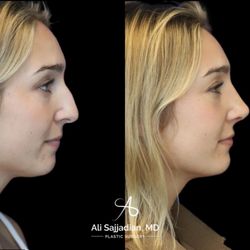 Ali Sajjadian, MD - Before and After | Surgical Rhinoplasty