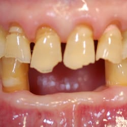 Yorktowne Dental Group - Before treatment view of severely compromised dentition