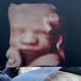 Photo of My Baby Debut 3D 4D Ultrasound