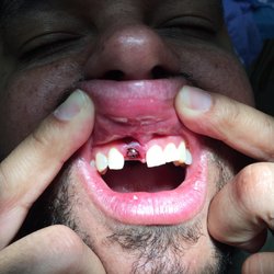 Periodontal Concepts - Perfectly clean dental implant done today 06/29/17 by Dr. Derhalli