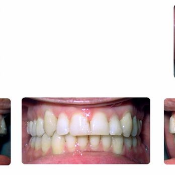 Holistic Orthodontics - After /2019 - Orthodontists Near Me - Northridge, California Holistic Orthodontics - After /2019 - Orthodontists Near Me - Northridge, California