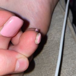 NY Nails - More fungus