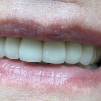 Keith Mitchell - AFTER VENEERS - General Dentistry Near Me - Irving, Texas Keith Mitchell - AFTER VENEERS - General Dentistry Near Me - Irving, Texas