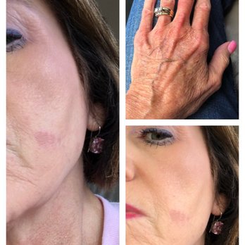 Castle Nail Spa - Day 2...3rd degree burn on my face is scabbing over. Hands still painful. - Nail Salons Near Me - Plano, Texas