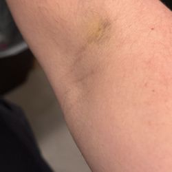 Labcorp - Is this normal ?(4 days after blood work still hurts)