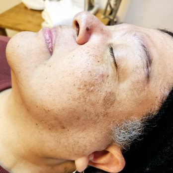 La Pelle Parlor - Before - Full face sugaring - Skin Care Near Me - Pasadena, California La Pelle Parlor - Before - Full face sugaring - Skin Care Near Me - Pasadena, California