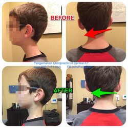 Pangemanan Chiropractic - Before and After FORWARD HEAD POSTURE corrected, with headaches history.