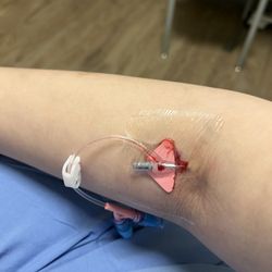 Bon Secours St. Mary's Hospital - After 5 pokes, this is the best they could do. I'm sure I'll be charged for the IV bag too.