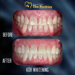 Raines Over The Rockies Family Dentistry - In-house whitening!