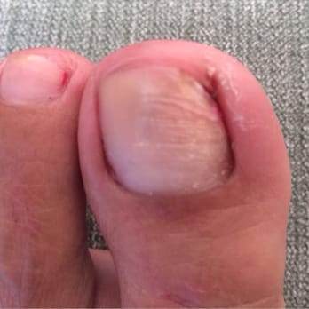 LV Nails - Post traumatic nail salon disorder. - Nail Salons Near Me - Palm Springs, California