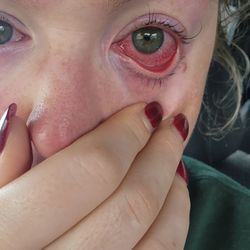 Skin Studio 211 - Chemical burns and abrasions