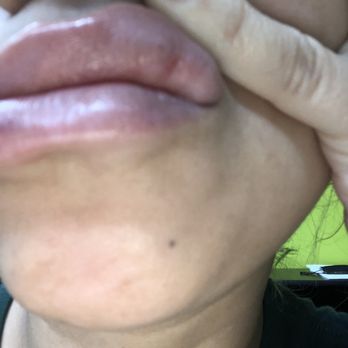 Beiamed Brows & Lashes - After two weeks this is what my lips look like today. - Skin Care Near Me - Miami, Florida Beiamed Brows & Lashes - After two weeks this is what my lips look like today. - Skin Care Near Me - Miami, Florida