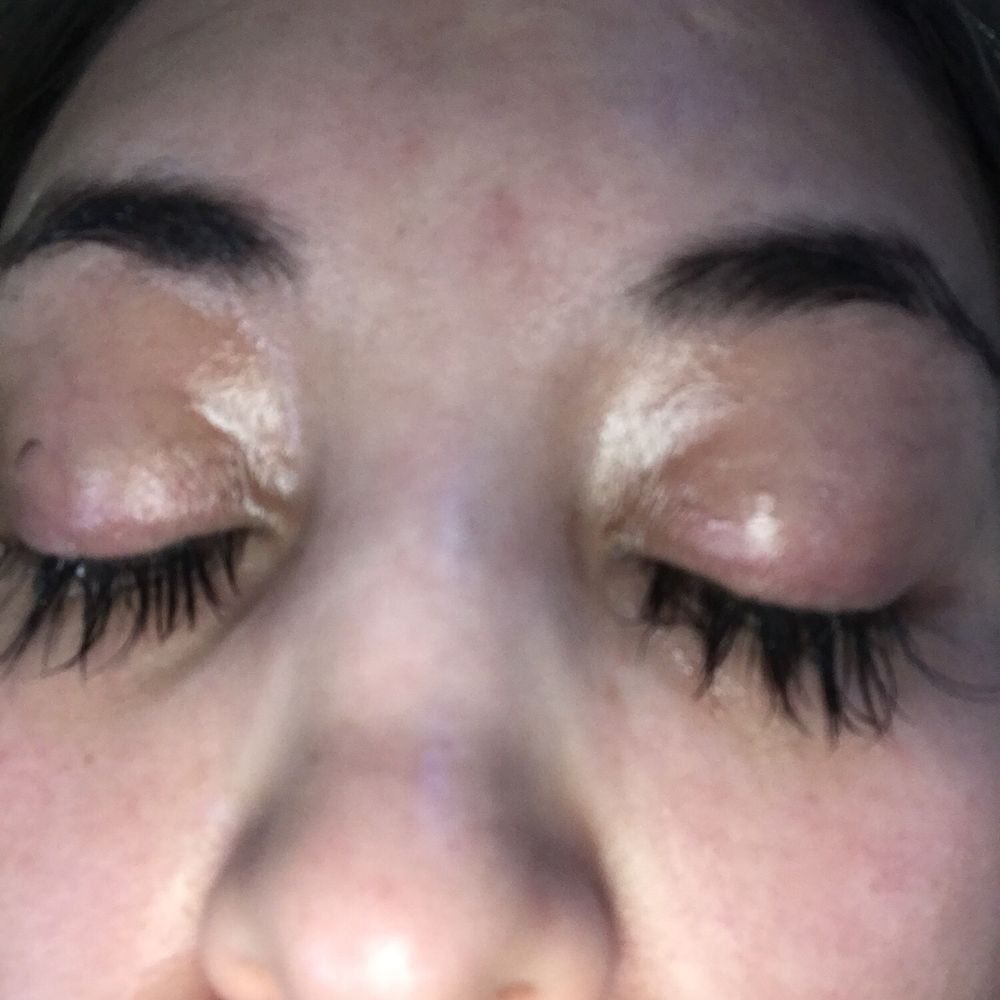 Skin Secrets & Threading - Swollen. Glue used was trash. Last clumps won't fall, none of my eyelashes remain. proof that she left me on red when I asked for help - Threading Services Near Me - Northglenn, Colorado